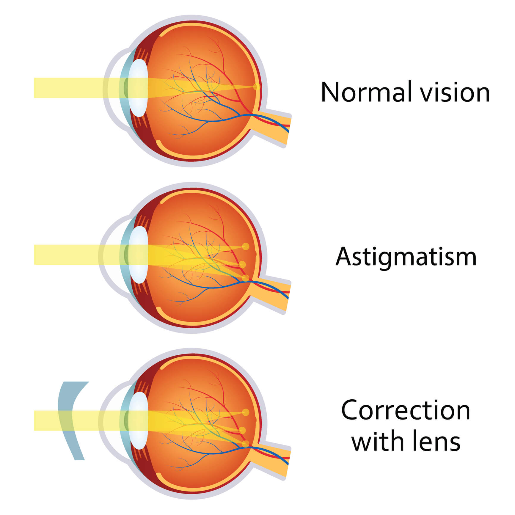 Diagram comparing normal vision, astigmatism, and correction with lens showing how light focuses on the retina