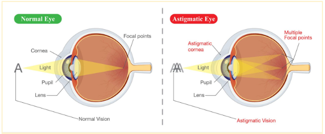 Diagram comparing normal vision and astigmatism with focal points and cornea shape