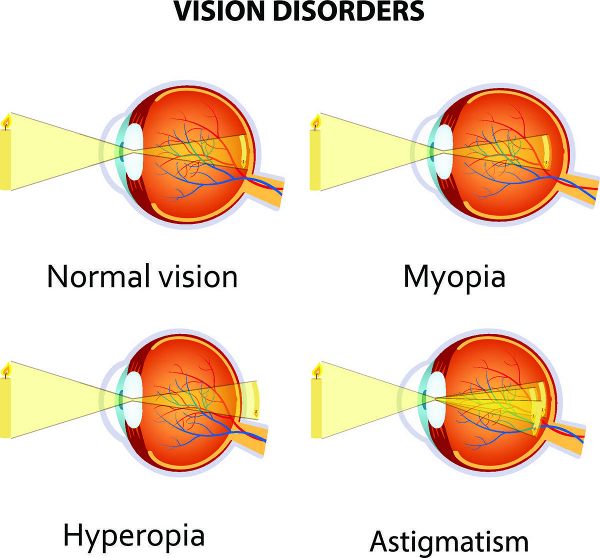 Chart of different eye issues