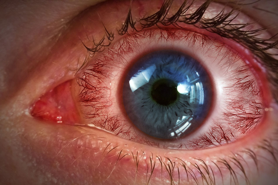 Close-up of heavily inflamed red eye