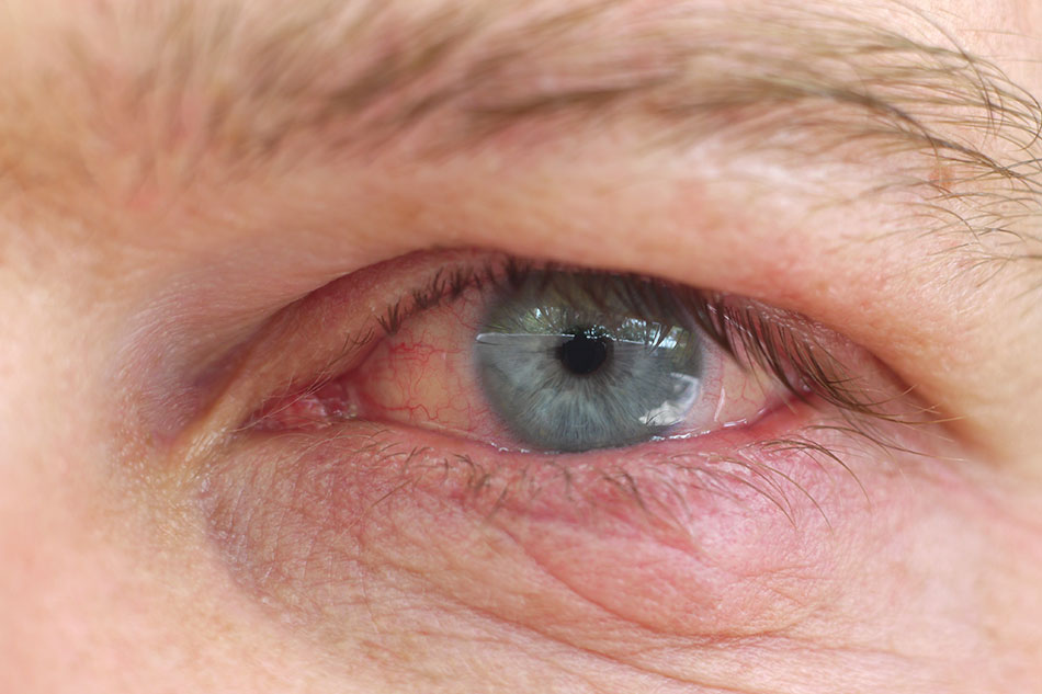 close up of man’s eye with dry contact lenses