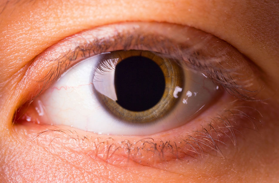 closeup of woman’s light brown eye with big pupil