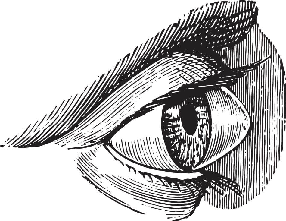 Diagram of eye with bulging cornea due to keratoconus