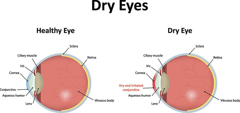 Illustration of healthy and dry eye anatomy