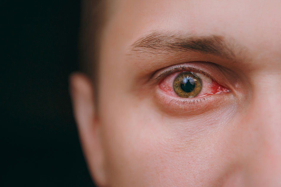 Close up of a man’s infected eye