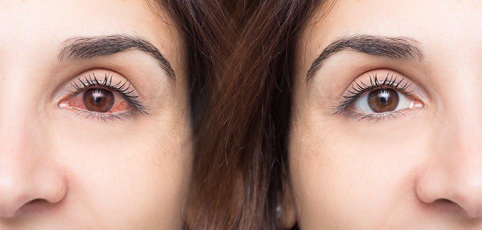 Two females: one with dry, red eyes, the other with healthy eyes