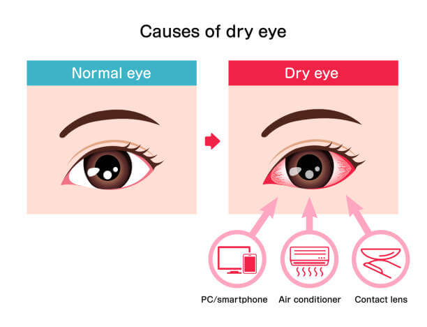 Causes of dry eye explained