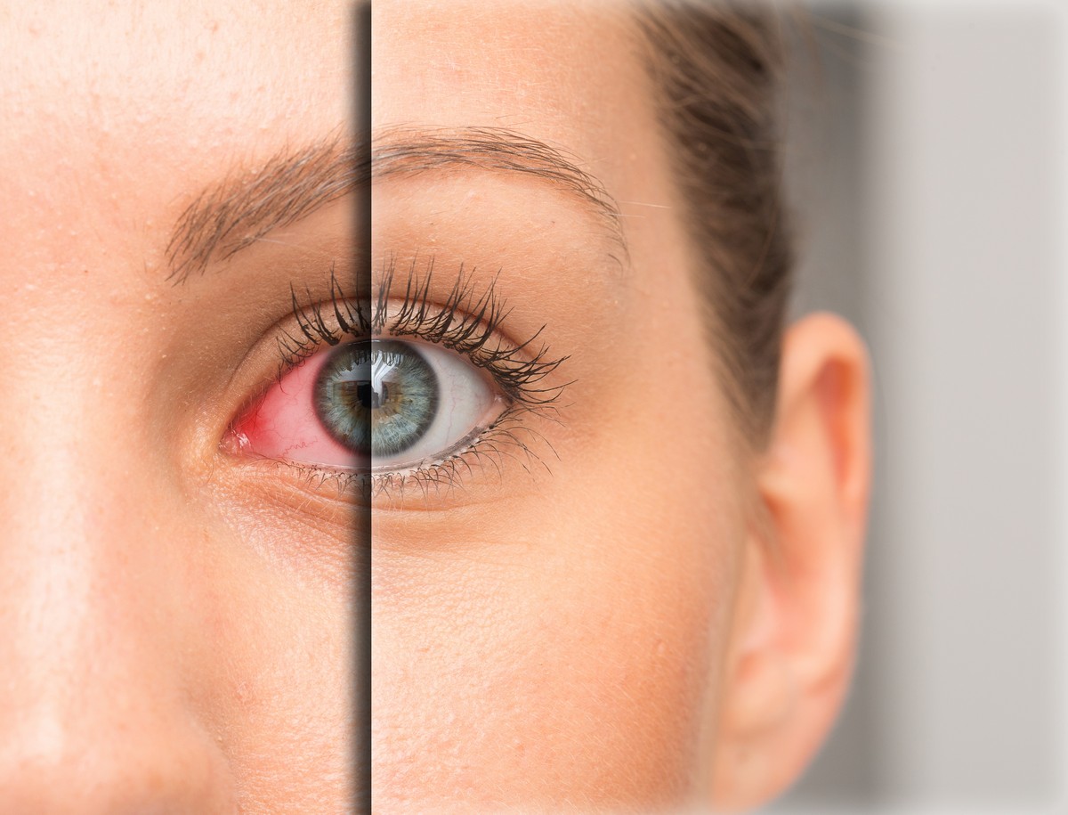 woman before and after split image of dry eye