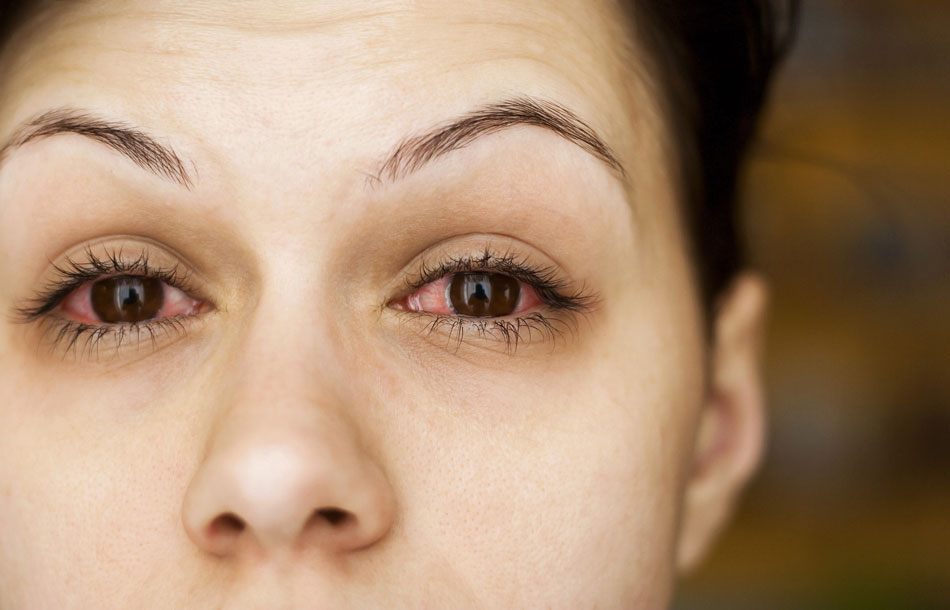 Woman with conjunctivitis